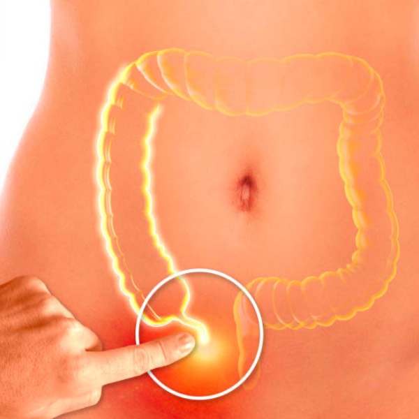 Apendicitis aguda