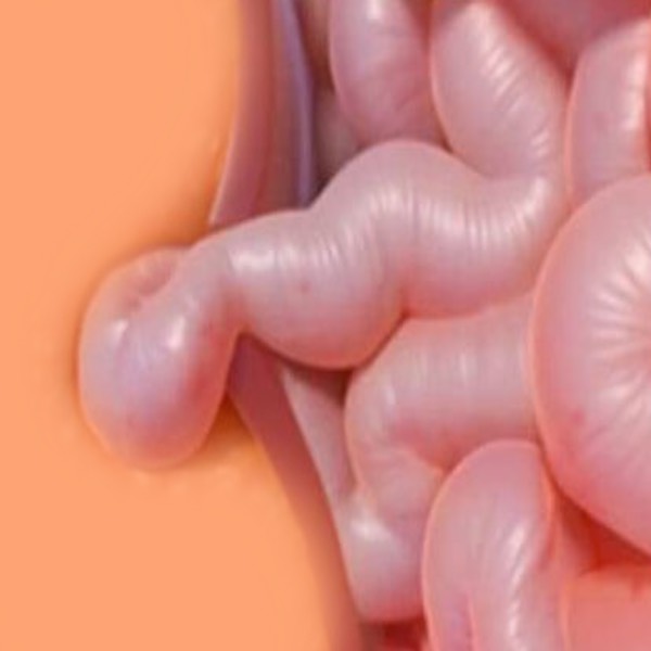 Hernias estranguladas