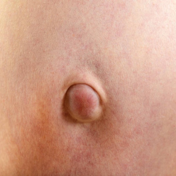 Cirugía de hernias de la pared abdominal